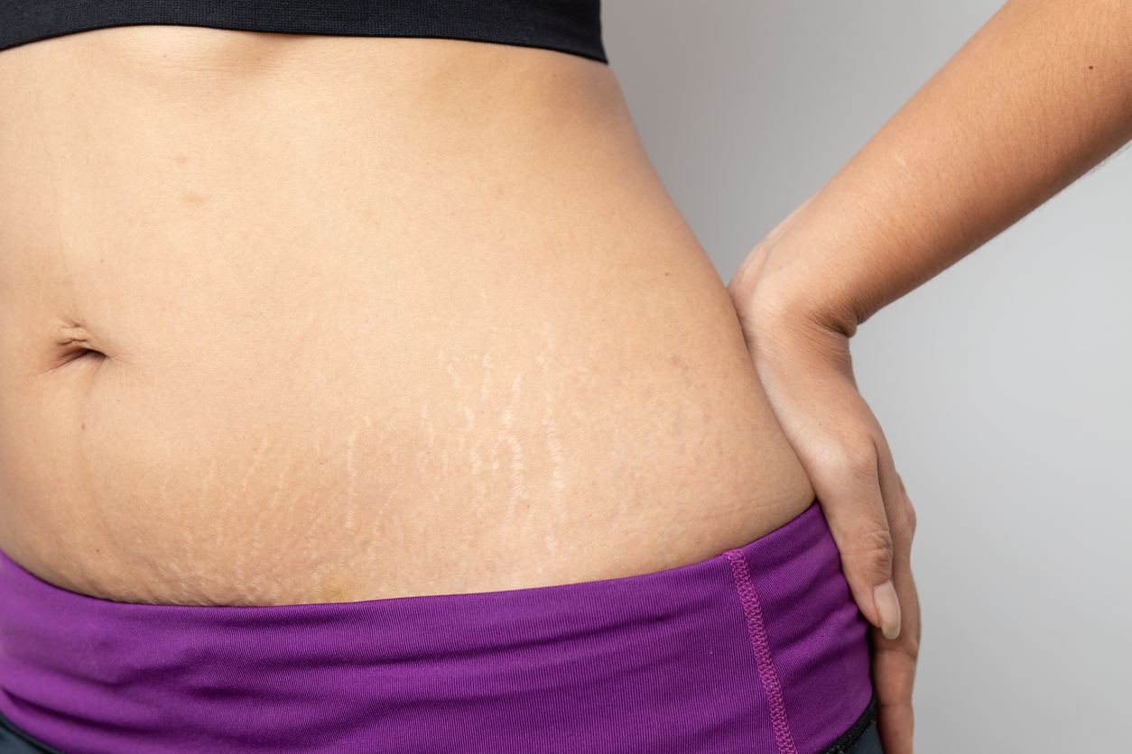 the-benefits-of-laser-stretch-mark-removal-techniques-health-n-medicare