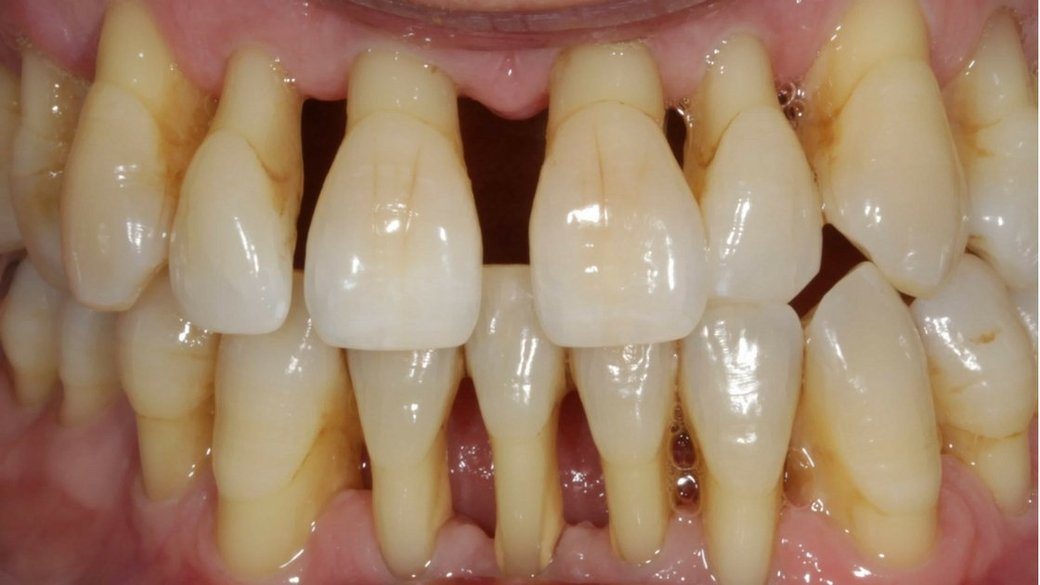 Periodontal Disease An Ultimate Guide Health N Medicare