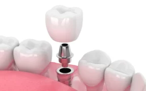 dental implants